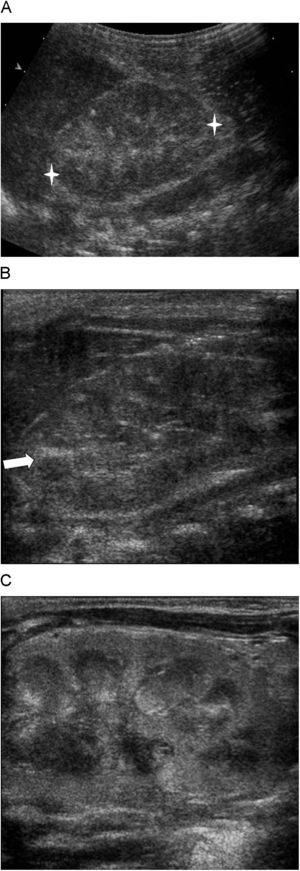 Hallazgos ecográficos en escala de grises característicos de la trombosis venosa renal neonatal. A) Nefromegalia y ecogenicidad heterogénea con pérdida de la diferenciación corticomedular. B) Bandas ecogénicas intramedulares. C) Hiperecogenicidad cortical con aumento de la diferenciación corticomedular de la fase hiperaguda.