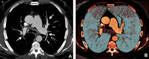 Tromboembolismo pulmonar (TEP) bilateral en un varón de 48 años con disnea, dolor torácico atípico y antecedente de carcinoma gástrico. El TEP afectaba a las ramas lobares de los lóbulos superiores e inferiores. A) Imagen axial representativa en proyección de máxima intensidad (MIP) en la que se demuestra el defecto de repleción (trombo) en ramas lobares de ambos lóbulos inferiores y lóbulo superior izquierdo. B) Imagen volumétrica reconstruida con parámetros optimizados para visualizar la perfusión pulmonar en la que se muestra la hipoperfusión relativa de los lóbulos superiores secundaria al tromboembolismo.