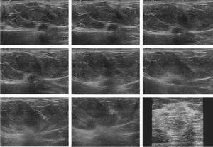 Serie de imágenes ecográficas obtenidas durante la ablación, tras la aplicación del electrodo de ARF. Se observa un empeoramiento progresivo de la delimitación del nódulo tumoral, acompañado de un aumento de su ecogenicidad, que finaliza con la formación de una masa palpable mal definida y de elevada ecogenicidad.
