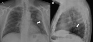 Radiografía de tórax proyección posteroanterior (A) y lateral (B). Lesión de bordes parcialmente bien definidos en la región posterosuperior del hemitórax izquierdo (flecha), sin signos de destrucción costal.