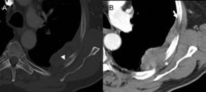 Tomografía computarizada con contraste intravenoso, ventana ósea (A) y ventana de partes blandas (B). Masa periférica de bordes bien definidos, realce homogéneo y ángulos obtusos con la pared torácica (flecha). Invade los planos grasos extrapleurales (asterisco) y contacta adelgazando la cortical del arco costal posterior (punta de flecha).