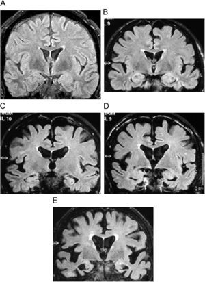 Demencia de Alzheimer. Imágenes coronales en FLAIR que muestran la evolución de la pérdida de volumen cortical temporal desde un estadio normal, grado 0 (A); deterioro cognitivo ligero, grado 1 (B); demencia leve, grado 2 (C), y avanzada, grado 4 (D).