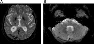 Angiopatía amiloide. A) Imagen axial potenciada en T2* donde se observa una hemorragia corticosubocrtical parietal posterior derecha. También se aprecia otro foco hemorrágico en cápsula interna. B) Nivel más inferior donde se observan otros focos hemorrágicos subcorticales en cerebelo.