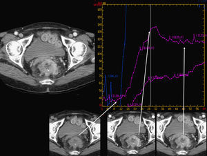 Estudio de TC-perfusión pélvico. Neoplasia rectal. Gráfica que representa el valor de atenuación (eje y) a lo largo del tiempo (eje x) y que muestra el realce del tumor a lo largo del tiempo de adquisición (flechas).