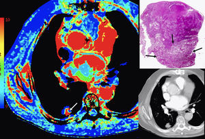 Estudio de TC-perfusión torácico. Neoplasia pulmonar. Mapa paramétrico del volumen sanguíneo (izquierda), espécimen patológico (tinción hematoxilina-eosina, micro-macro) e imagen de adquisición (abajo derecha) mostrando un área del nódulo (flecha blanca) con altos valores de BV que se correlaciona con la zona tumoral viable (flechas negras). El resto del nódulo muestra necrosis.