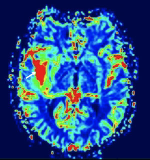 RM cerebral. Imagen de perfusión cerebral con técnica T2*. Glioblastoma multiforme. Mapa paramétrico del BV cerebral con área de píxeles rojos, que representan altos valores, en el tumor (flecha blanca). (Cortesía Dra. Laura Oleaga, Hospital Clínic, Barcelona).