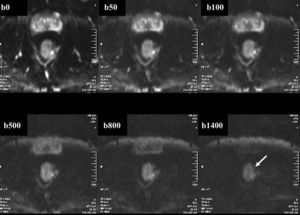 RM pélvica. Secuencia de difusión. Neoplasia rectal. Imagen que muestra la variación de la señal al aumentar el factor b y como en b=1.400 mantiene la señal únicamente el tumor (flecha).