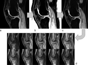 a) Imagen para segmentación. b) Segmentación de la imagen en base a la información de intensidades de gris. c) Selección del cartílago patelar. d) Propagación de la región seleccionada a las imágenes con múltiples ángulos de inclinación para el cálculo de los mapas de T1.