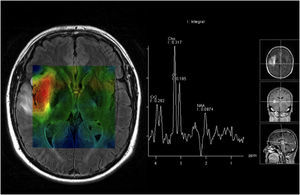 Resonancia magnética cerebral. Espectroscopia. Glioblastoma multiforme (cortesía de la Dra. Laura Oleaga, Hospital Clínic, Barcelona). Imagen paramétrica de concentración de colina (alta concentración en rojo) y gráfica que muestra un pico acentuado de colina.