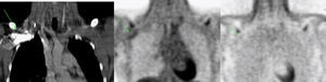 Imágenes de tomografía computarizada y tomografía por emisión de positrones (PET) con y sin corrección de atenuación. En la tomografía computarizada se identifica contraste de alta densidad en la vena axilar derecha que causa artefacto por sobrecorrección en la imagen PET, lo que puede crear confusión en ésta al simular una lesión con aumento de metabolismo. En la PET sin corregir se comprueba que se trata de un artefacto, ya que no se visualiza zona de hipermetabolismo a esa altura.