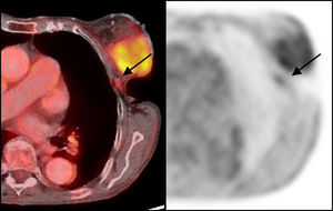 Imágenes de fusión de tomografía por emisión de positrones y tomografía computarizada y tomografía por emisión de positrones a nivel torácico en las que se observa una adenopatía axilar izquierda de pequeño tamaño, con depósito patológico de fluoro-2-desoxi-D-glucosa en una mujer con cáncer de mama localmente avanzado.
