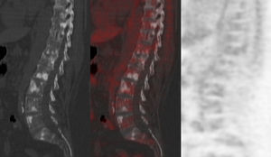 Imágenes de tomografía computarizada, fusión de tomografía por emisión de positrones y tomografía computarizada y tomografía por emisión de positrones de una mujer con cáncer de mama en tratamiento con quimioterapia en la que se evidencian múltiples lesiones blásticas en la columna vertebral en relación con metástasis, sin depósito de fluoro-2-desoxi-D-glucosa.