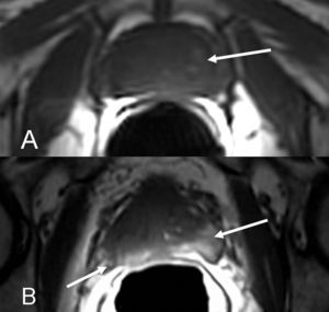 Anatomía en corte axial, secuencia ponderada en T1. A) Señal isointensa difusa normal de la glándula sin diferenciar zona central o periférica, y algunas zonas más hiperintensas de adenoma sin traducción patológica (flecha). B) Señal hiperintensa en ambos lóbulos periféricos secundaria a hemorragia postbiopsia (flechas) con asimetría del plexo neurovascular de causa no infiltrativa.