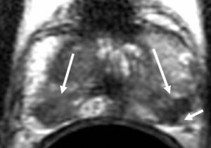 Cambios postbiopsia. Neoplasia de próstata bilateral (flechas largas) con espiculación de la región capsular izquierda (flecha pequeña) cuatro semanas tras la biopsia, que podría sugerir extensión extracapsular. La anatomía patológica mostró neoplasia intracapsular.