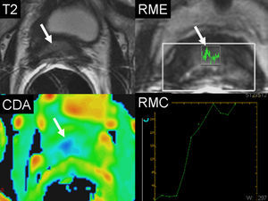 Recidiva postratamiento con ultrasonido focal de alta intensidad (HIFU). Varón de 69 años con nivel de PSA de 1,2ng/ml 1 año después a tratamiento con HIFU. A) Atrofia glandular con señal hipointensa difusa (flecha) en la secuencia ponderada en T2. La RME muestra elevación del pico de la colina (flecha) indicativa de proceso neoplásico. La RMD en el mapa paramétrico del CDA muestra un valor bajo traducido por el color azul (flecha). La curva intensidad/tiempo de la RMC muestra una pendiente elevada por captación precoz del medio de contraste en relación con recidiva tumoral.