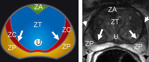 Esquema anatómico axial de la próstata del adulto con correlación con corte axial de secuencia ponderada en T2. Señal hiperintensa normal de la zona periférica (ZP). Zona central (ZC) o cápsula quirúrgica-pseudocápsula (flechas blancas). Zona transicional (ZT) con hipertrofia heterogénea hipointensa normal. Cápsula verdadera (cabezas de flechas blancas). Plexo neurovascular (cabezas de flechas negras). Zona anterior fibroestromal (ZA).