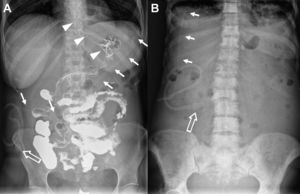 A) Radiografía abdominal de la paciente número 4 donde se observa la porción intraperitoneal (flechas rectas) y externa del catéter tunelizado así como la válvula unidireccional (flecha hueca). Sonda nasogástrica (puntas de flecha). B) Radiografía abdominal de la paciente número 1 que muestra la posición intraperitoneal del catéter tunelizado (flechas rectas) y la porción externa del mismo con la válvula unidireccional (flecha hueca).