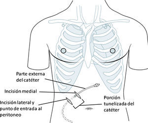 Imagen modificada obtenida del libro de instrucciones del producto donde se explica de manera esquemática la colocación el catéter.