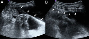A) Imagen ecográfica obtenida durante la colocación del catéter donde se observa la guía metálica de punta en J (flechas rectas). B) Imagen ecográfica obtenida tras la colocación del catéter. Se aprecian las porciones tunelizada e intraperitoneal del catéter (flechas rectas).