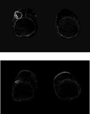 Respuesta concéntrica. En la RM de estadificación (a) se identifica un tumor adyacente a la prótesis de mama. En el estudio posttratamiento (b) se evidencia una respuesta parcial mayor concéntrica. En este caso, debido a la proximidad del tumor a la prótesis, se extirpó ésta conjuntamente con el tumor.