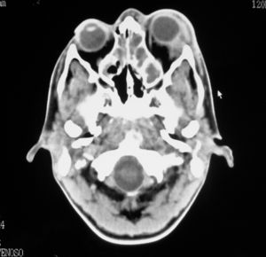 TC axial con contraste intravenoso. Ocupación de las celdillas etmoidales. Glándula lagrimal izquierda aumentada de tamaño que presenta intenso realce con contraste. Engrosamiento de las partes blandas preseptales en relación con celulitis preseptal.