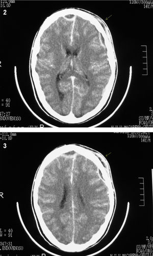 TC axial con contraste intravenoso que muestra con flecha absceso subperióstico (tumor hinchado de Pott) como una colección hipodensa externa al hueso frontal así como 2 abscesos epidurales con realce periférico a nivel frontal derecho e izquierdo.