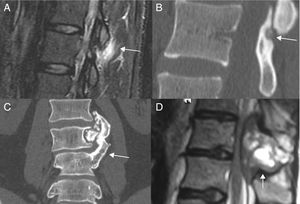 Osteoma Osteoide. A) RM que demuestra edema hiperintenso en STIR (flecha). B) TC sagital que demuestra una pequeña lesión osteolítica (flecha). C) TC coronal. Osteocondroma. D) RM sagital T2. Tumor de células gigantes de la apófisis espinosa.