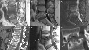 Espondilodiscitis. Sagital T1 sin (A) y con contraste (B), STIR (C) de una infección piógena con patrón de edema y absceso epidural (flecha). D) Destrucción de las plataformas vertebrales de otra discitis en TC. E) y F) RM sagital T1 (E) y TC (F) sagital que muestran destrucción de plataformas en osteocondrosis intervertebral erosiva secundaria a listesis degenerativa. La presencia de aire intradiscal e intervertebral ayudó al diagnóstico.