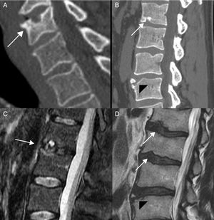A) TC sagital con hernia de Schmorl cervical (flecha). B) TC sagital con hernias de Schmorl lumbar (flechas). Hernia retromarginal (cabeza de flecha) (B). C) RM sagital STIR con hernia de Schmorl y discreto edema (flecha). D) RM sagital T2 con hernia retormarginal (cabeza de flecha) e irregularidad de las plataformas vertebrales (flechas) en paciente con enfermedad de Scheuermann lumbar.