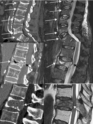 A-D) Fracturas por insuficiencia en osteoporosis. TC sagital con bandas de esclerosis subcondral (A) que se corresponde con patrón de edema en banda en secuencia sagital STIR (flechas) (B). TC sagital (C) y sagital STIR (D) demostrando una hendidura intravertebral (flecha) y retropulsión del margen posterosuperior (flecha negra). E) y F) Fracturas patológicas. TC sagital de metástasis de carcinoma renal (E) y sagital T2 (F) de metástasis de pulmón, demostrando convexidad del borde posterior (flecha).