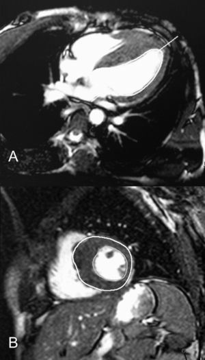 Angiorresonancia magnética cardiaca. Imagen en: A) plano cuatro cámaras, y B) eje corto, donde se observa hipertrofia asimétrica anteroseptal.
