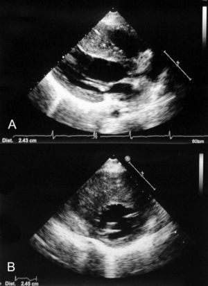 A) Eje paraesternal largo ecocardiográfico, donde se evidencia hipertrofia grave del septo interventricular. B) Corte ecocardiográfico paraesternal corto a nivel ventricular, donde se objetiva hipertrofia asimétrica del territorio anteroseptal, alcanzando en el septo interventricular un grosor de 24mm.