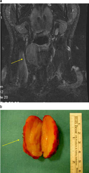 a) Coronal STIR. b) Pieza quirúrgica. Masa ovoide, compacta y encapsulada, que guarda una gran correlación anatomorradiológica (flecha).