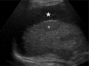 Se aprecia una lesión focal de baja ecogenicidad (a) y una imagen hipoecoica (hematoma) adyacente al hígado (asterisco).