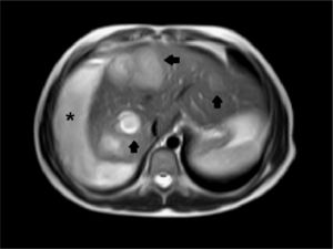 Todas las lesiones brillan (flechas). El hematoma (asterisco) tiene elevada intensidad también.