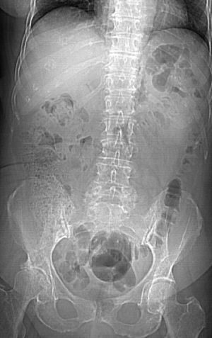 Radiografía simple de abdomen.