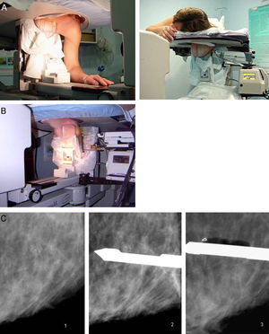 Técnica de estereotaxia mediante utilización de sistema de biopsia asistido por vacío (BAV). A) Colocación de la paciente en la mesa prona. Para acceso a la cola mamaria es útil la colocación del brazo en la abertura; B) Punción con sistema de BAV con cánula de calibre 11G (acceso lateral); C) Biopsia con cánula de sistema asistido por vacío 11G de calcificaciones. Tras su extirpación se coloca un clip de marcado del lecho de biopsia.
