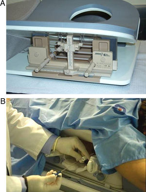 Técnica de BAV guiada por resonancia magnética. A) Dispositivo de guía para biopsia con resonancia magnética; B) Colocacion del aparato de BAV para realización de la biopsia.