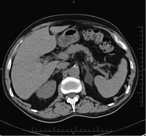 Adenoma suprarrenal. TC abdominal en un paciente de 72 años, en estudio por un aneurisma de la aorta abdominal infrarrenal. En el estudio basal se observa una lesión nodular hipodensa en la glándula suprarrenal izquierda, con valores de atenuación de -13 UH, compatible con un adenoma.
