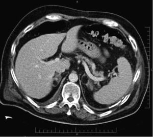 Mielolipoma. TC abdominal con contraste endovenoso en fase portal realizada en un paciente de 61 años por un postoperatorio complicado de prostatectomía radical. Se observan lesiones bilaterales con predominio de densidad grasa, compatibles con mielolipomas.