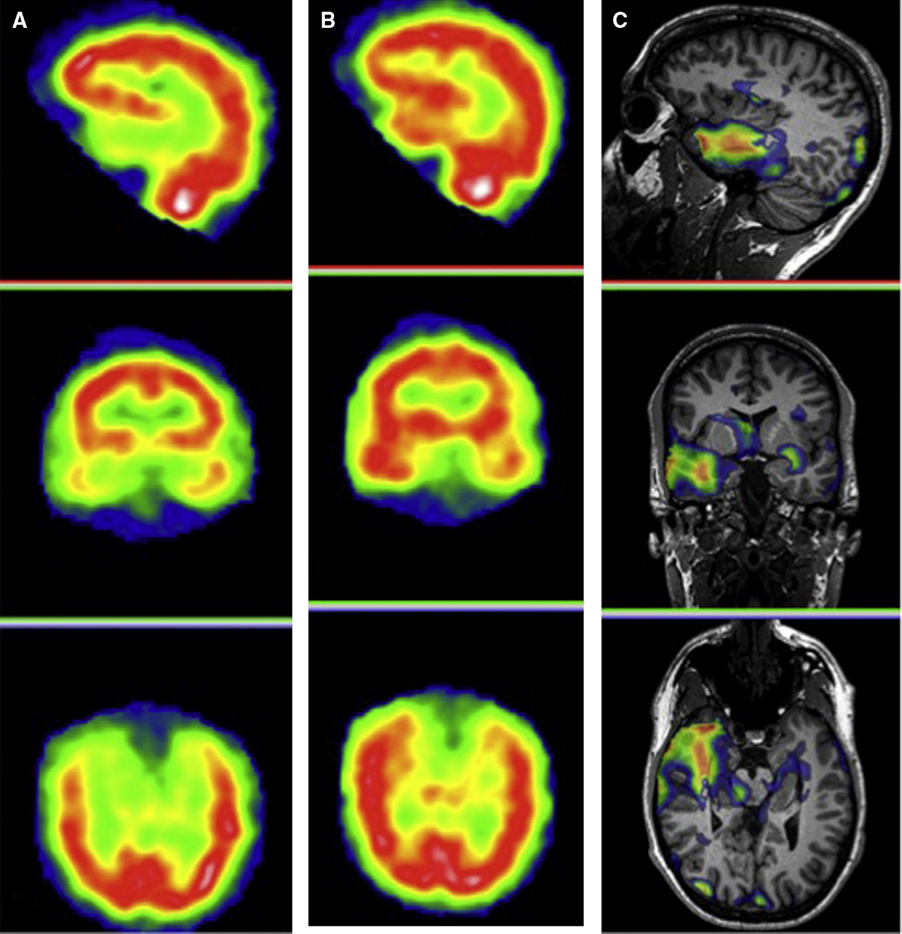Imagen en epilepsia: estudios funcionales | Radiología