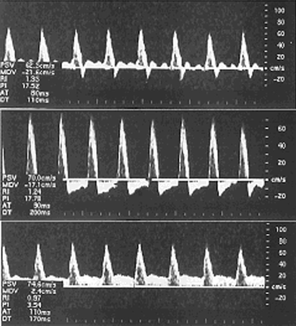 Flujo retrógrado diastólico. Comunicación preliminar | Radiología