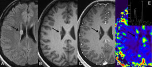 RM cerebral con secuencias FLAIR (A), T1 pre-contraste (B), T1 postcontraste (C), perfusión con gadolinio (D) y espectroscopia de protón por RM (E) de una lesión (flecha) adyacente al ventrículo lateral derecho con alta señal en FLAIR, sin realce postcontraste, bajo volumen sanguíneo cerebral y niveles normales de Cho/Cr and NAA/Cr, compatible con un pólipo hiperplásico astrocítico. En estos pólipos, las células madres permanecen en la zona subventricular y no migran hacia la periferia del cerebro.