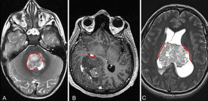 RM cerebral con imágenes axiales ponderadas en T2 (A y C) y T1 postcontraste (B). Los ependimomas se localizan a lo largo de las cavidades revestidas por células ependimarias (líneas rojas) y generalmente en la medula espinal y en el interior del cuarto ventrículo (A) aunque también pueden localizarse en el compartimento supratentorial tanto en los hemisferios cerebrales (B) como intraventricular (C). Los ependimomas supratentoriales tienden a originarse en regiones vecinas a la zona subventricular.