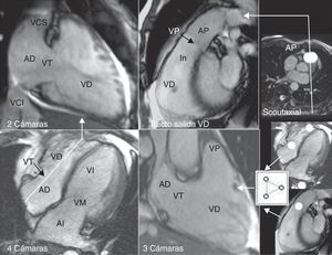 Planos empleados en RM para estudiar el ventrículo derecho: 4 cámaras, 2 cámaras derechas, 3 cámaras derechas y tracto de salida del ventrículo derecho (AD: aurícula derecha; AI: aurícula izquierda; AP: arteria pulmonar; In: infundíbulo; VD: ventrículo derecho; VCI: vena cava inferior; VCS: vena cava superior; VI: ventrículo izquierdo; VM: válvula mitral; VP: válvula pulmonar; VT: válvula tricúspide).