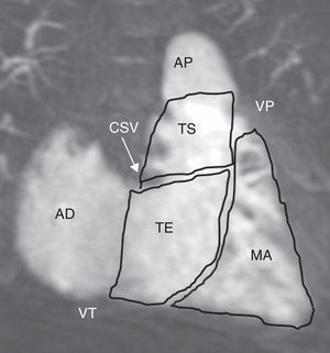 Anatomía regional del ventrículo derecho: MIP fino de angio-RM 3D contrastada en las cavidades derechas, con efecto ventriculográfico, demostrando la división del VD en tracto de entrada (TE), tracto de salida (TS) y miocardio apical (MA) (AD: aurícula derecha; AP: arteria pulmonar; CSV: cresta supraventricular; VD: ventrículo derecho; VT: válvula tricúspide).