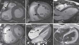 Estructuras características del ventrículo derecho: cresta supraventricular (CSV), trabécula septomarginal (TSM), banda moderadora (BM), músculo papilar anterior (MPA) (VD: ventrículo derecho; VI: ventrículo izquierdo).