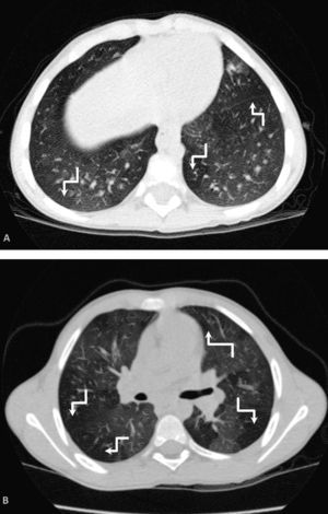 Extensión del enfisema. A) Áreas de enfisema que afectan a 4 segmentos pulmonares de forma bilateral (flechas rotas). B) Áreas de hipoatenuación en relación con enfisema que afectan a más de 5 segmentos en ambos pulmones. Algunos de los segmentos afectos se indican mediante flechas rotas. Los hallazgos corresponderían a 1 y 2 puntos respectivamente.