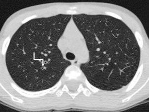 Valoración de la extensión de las bronquiectasias. Considerando que el resto del parénquima pulmonar esté libre de lesiones objetivamos bronquiectasias (flecha rota) limitadas a un segmento del lóbulo superior derecho (1 punto Bhalla).
