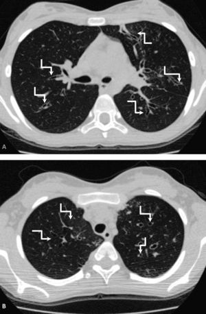 A y B) Valoración de la extensión de las bronquiectasias. Ambas imágenes, de un mismo paciente, muestran la extensión de bronquiectasias a más de 9 segmentos. Se indican algunos de los segmentos afectados mediante flechas rotas (3 puntos Bhalla).